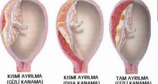 Dekolman Plasenta Risk Faktörleri