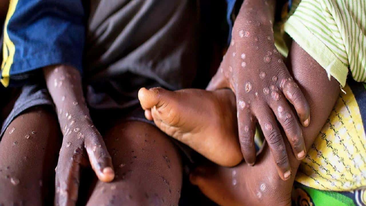 Kenya'da Mpox Vakası Tespit Edildi: Sağlık Önlemleri Alınıyor