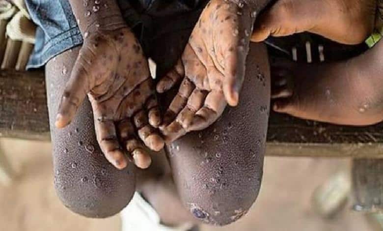 Kenya'da Mpox Vakası Tespit Edildi: Sağlık Önlemleri Alınıyor