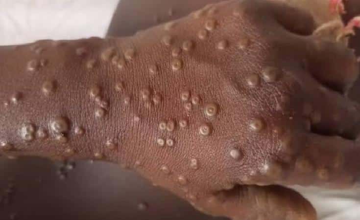 Kenya'da Mpox Vakası Tespit Edildi: Sağlık Önlemleri Alınıyor