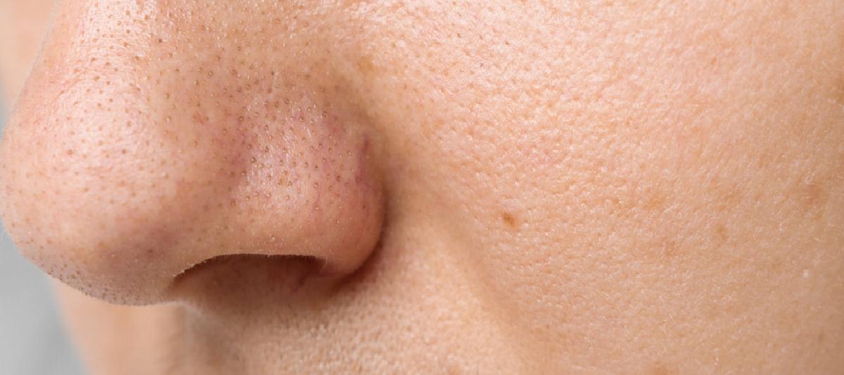 Rosacea ve Belirtileri