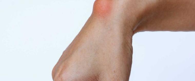 Ganglion Kisti Nedir?