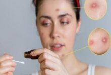 Woman applies liquid from a dropper to her face; inset close-ups show pimples on the forehead and cheek.