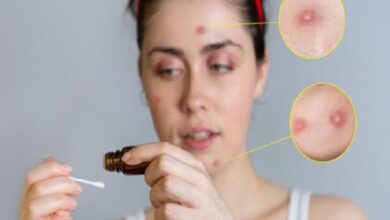 Woman applies liquid from a dropper to her face; inset close-ups show pimples on the forehead and cheek.